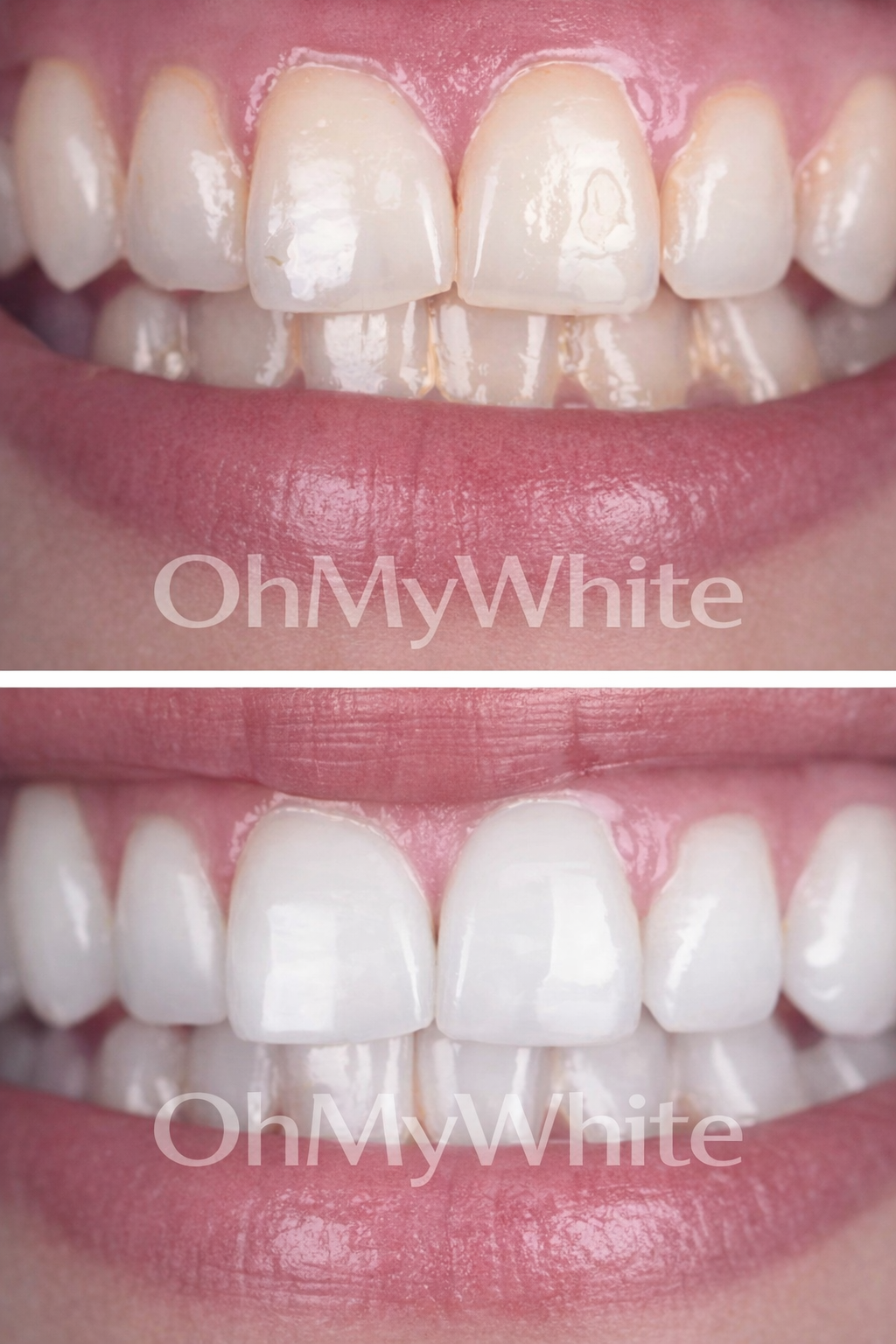 Oh My White™ - Bandes Blanchissantes Correctrices